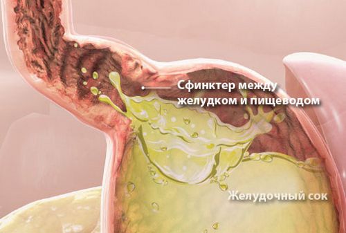 ماذا تفعل إذا كان لديك حرقة