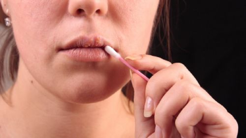 طرق فعالة لعلاج نزلات البرد على الشفاه