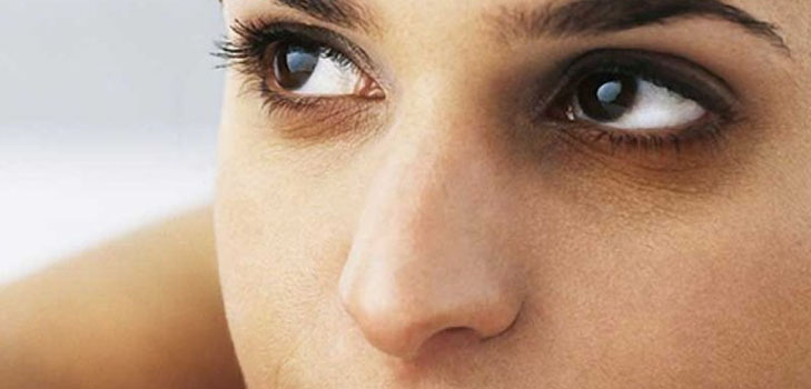 علاج لكدمات تحت العينين
