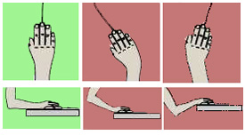 متلازمة النفق